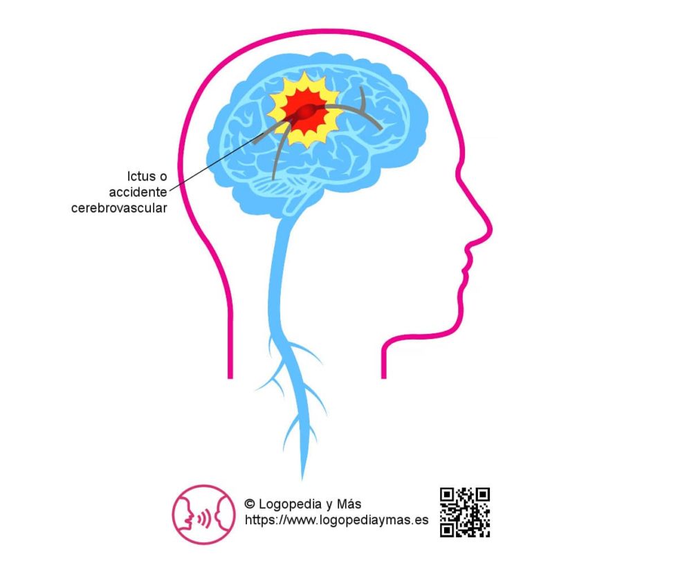 Qu Es Un Ictus S Ntomas Secuelas Y Tratamiento