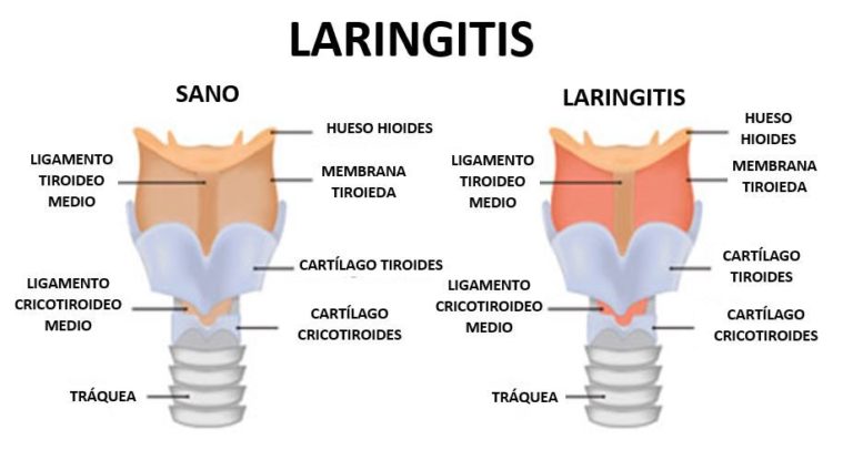 ¿qué Es La Laringitis 🥇 SÍntomas Y Tratamiento